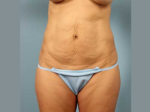 J Plasma Before and After 02