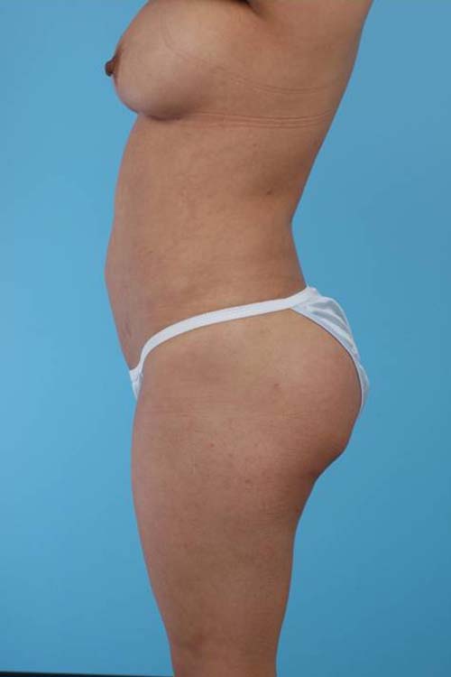 Liposuction Before and After 21