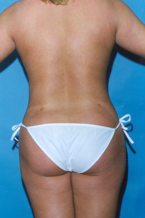 Liposuction Before and After 19