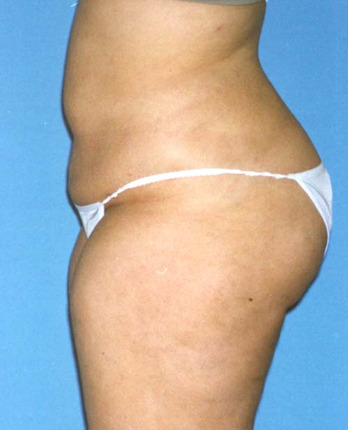 Liposuction Before and After 11