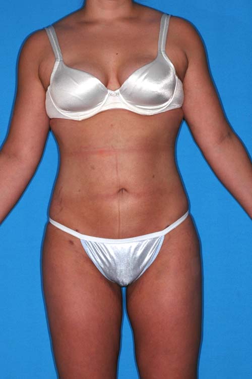 Liposuction Before and After 12