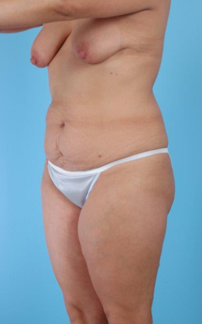 Mommy Makeover Before and After 08