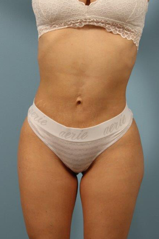 Renuvion Jplasma Body Contouring Before and After 10