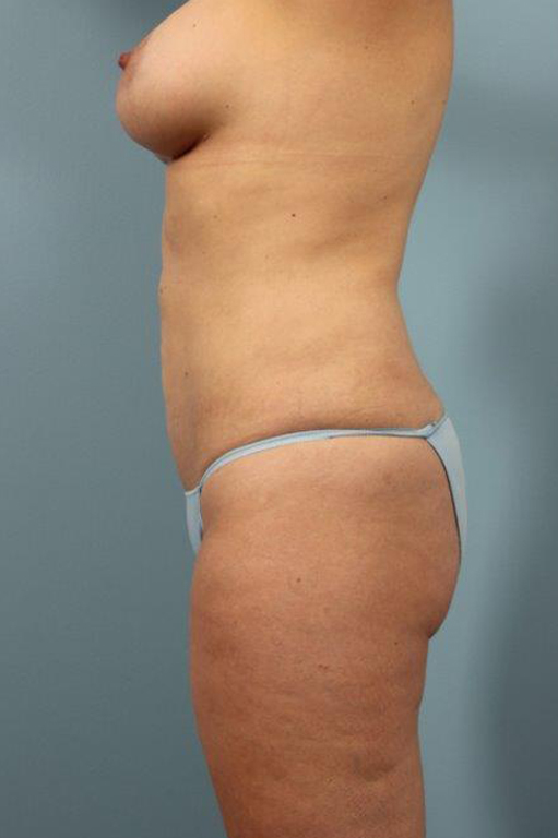 Renuvion Jplasma Body Contouring Before and After 05