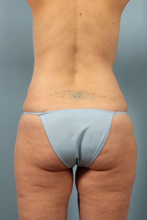 Renuvion Jplasma Body Contouring Before and After 05
