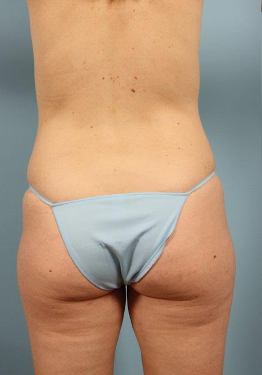 Renuvion Jplasma Body Contouring Before and After 06