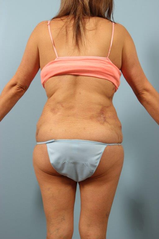 Renuvion Jplasma Body Contouring Before and After 09