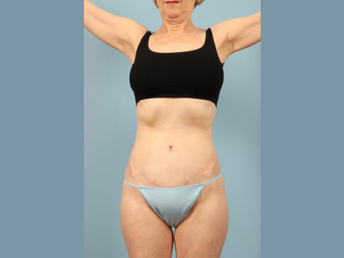 Renuvion Jplasma Body Contouring Before and After 13