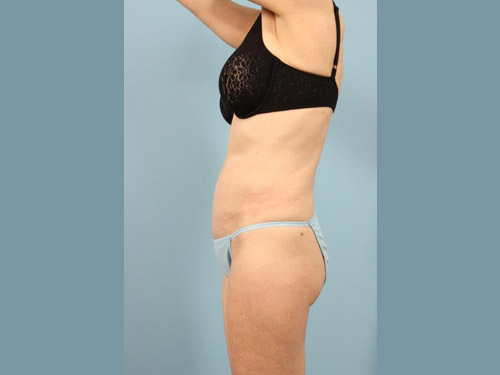 Renuvion Jplasma Body Contouring Before and After 10
