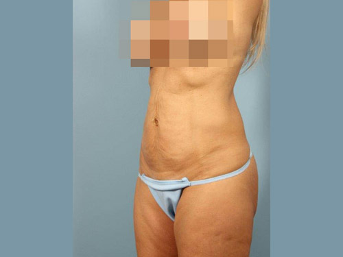 Renuvion Jplasma Body Contouring Before and After 11