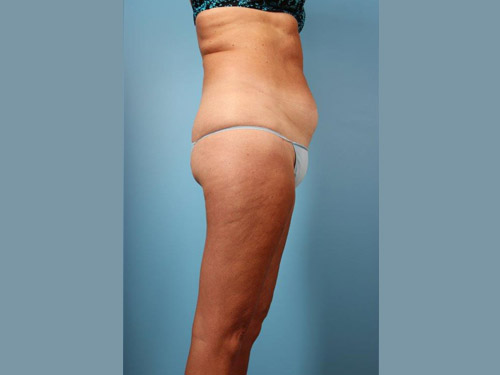 Renuvion Jplasma Body Contouring Before and After 12