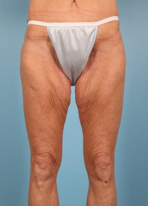 Thigh Lift Before and After 01
