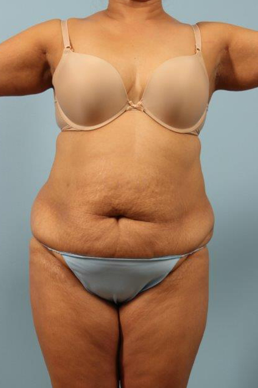 Tummy Tuck Before and After 03