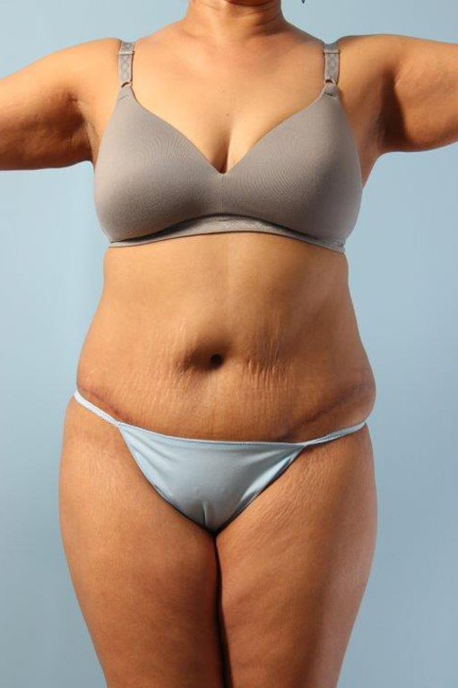 Tummy Tuck Before and After 55