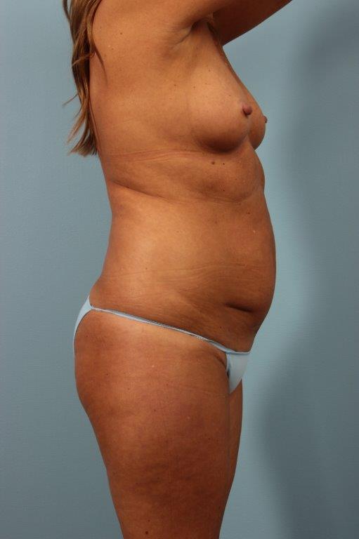 Tummy Tuck Before and After 04