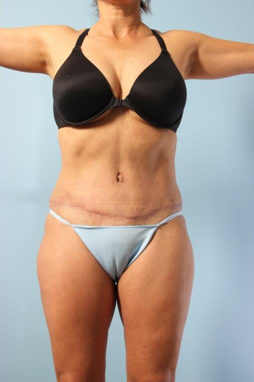Tummy Tuck Before and After 49
