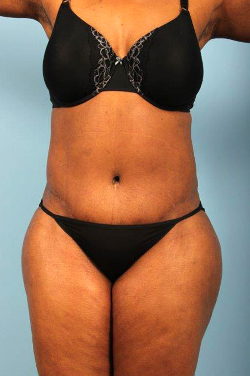 Tummy Tuck Before and After 37