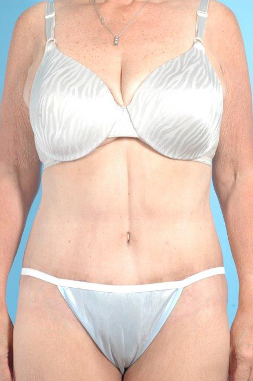 Tummy Tuck Before and After 57