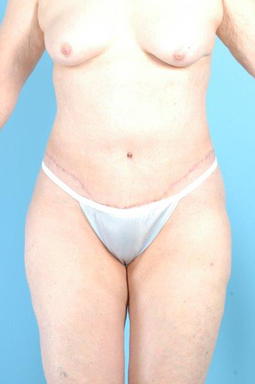 Tummy Tuck Before and After 32