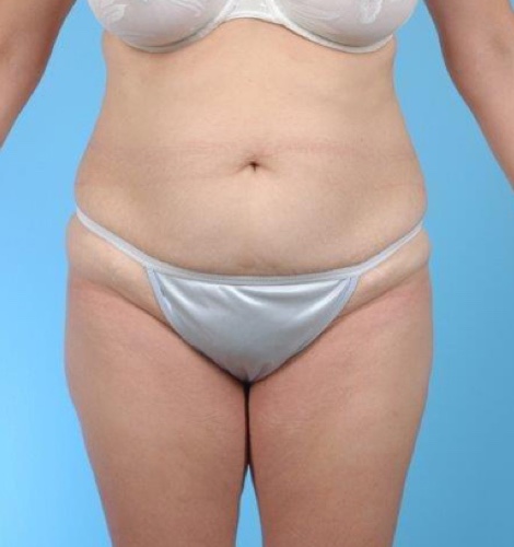 Tummy Tuck Before and After 13