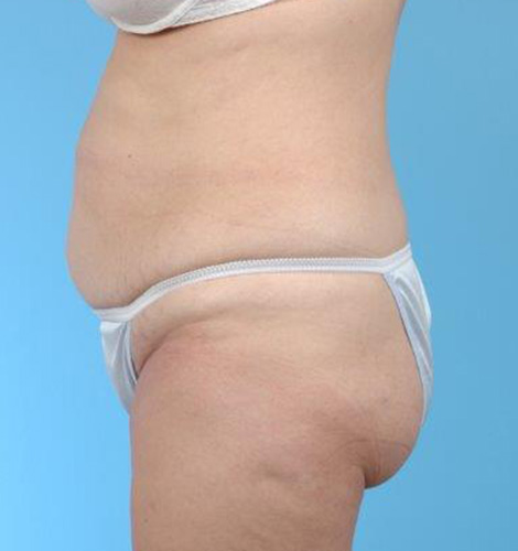 Tummy Tuck Before and After 13