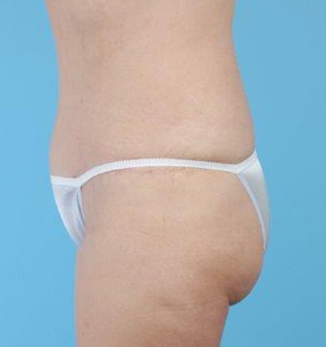 Tummy Tuck Before and After 13