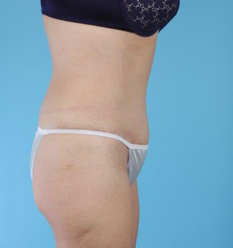 Tummy Tuck Before and After 13