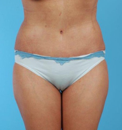 Tummy Tuck Before and After 06
