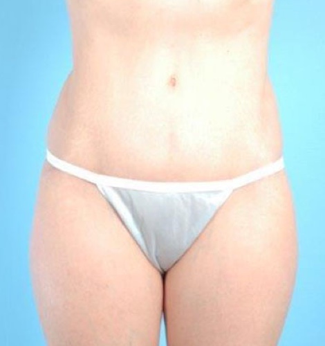 Tummy Tuck Before and After 56