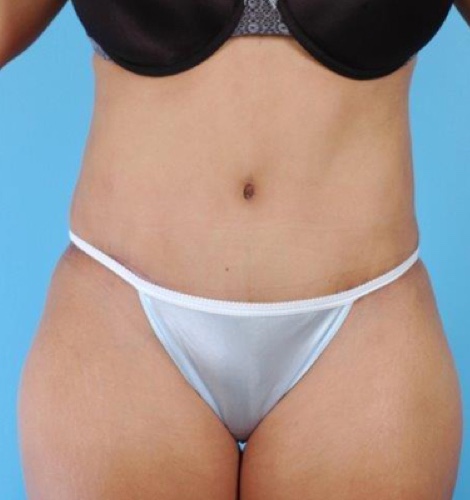 Tummy Tuck Before and After 02