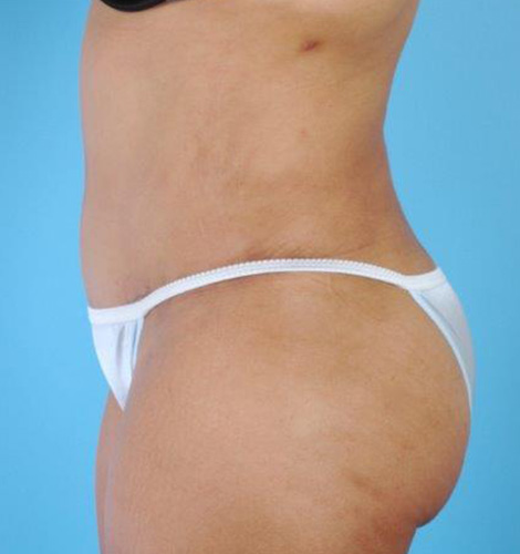 Tummy Tuck Before and After 20