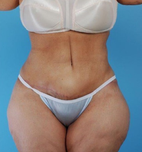 Tummy Tuck Before and After 45