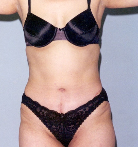Tummy Tuck Before and After 37