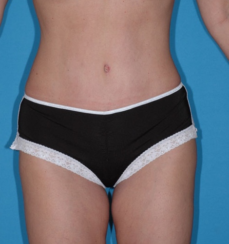 Tummy Tuck Before and After 39