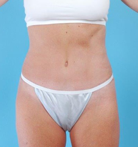 Tummy Tuck Before and After 59