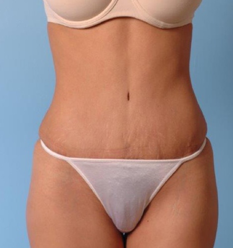 Tummy Tuck Before and After 36