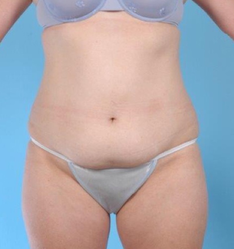 Tummy Tuck Before and After 32