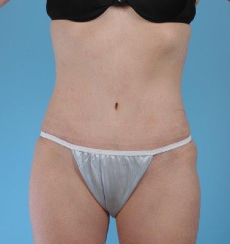 Tummy Tuck Before and After 43