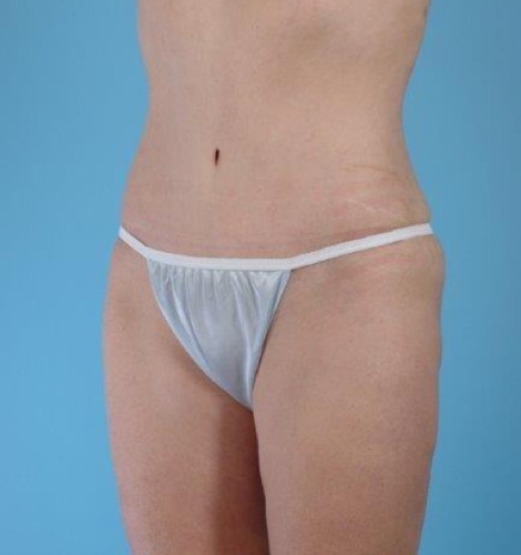 Tummy Tuck Before and After 32