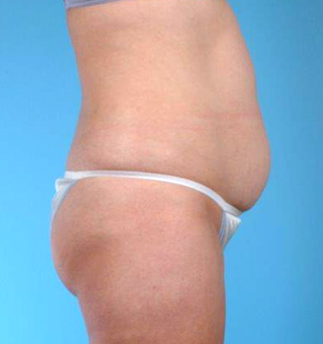 Tummy Tuck Before and After 32