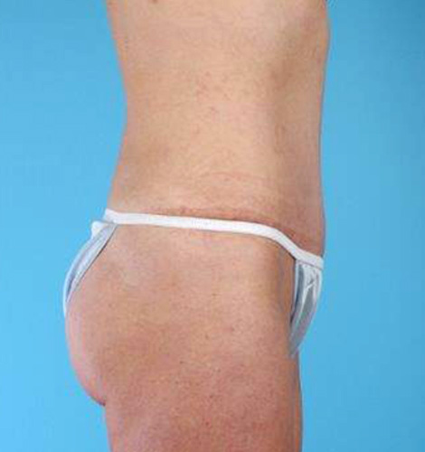 Tummy Tuck Before and After 32