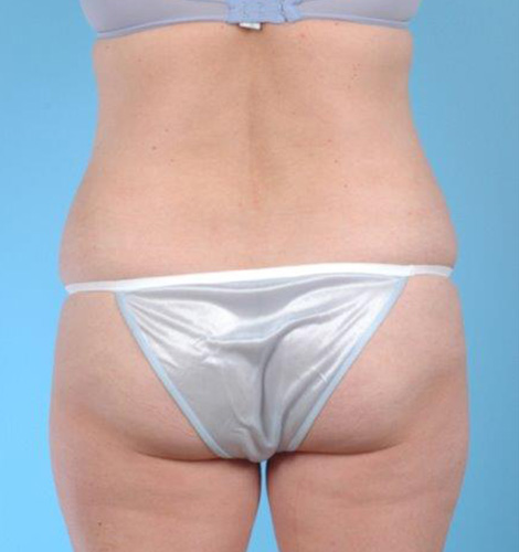Tummy Tuck Before and After 32