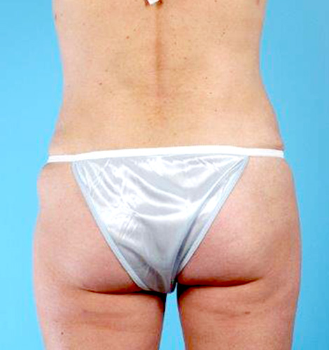 Tummy Tuck Before and After 32