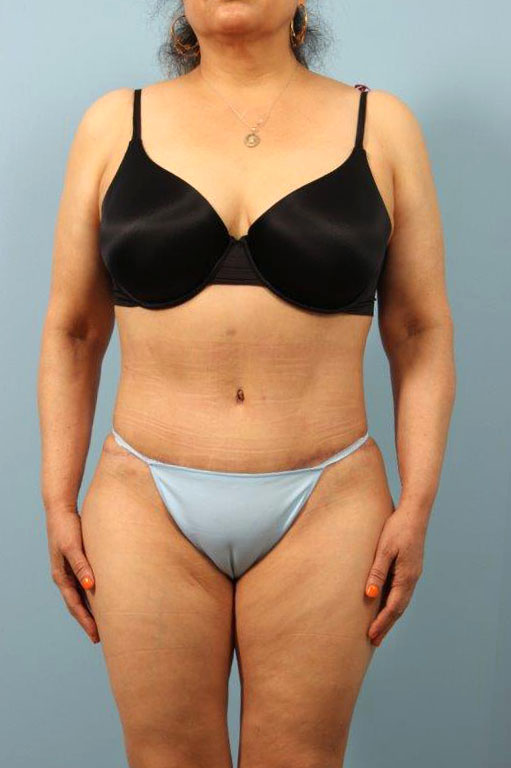 Tummy Tuck Before and After 04