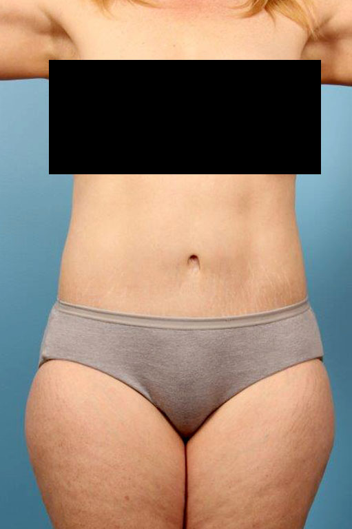 Tummy Tuck Before and After 16