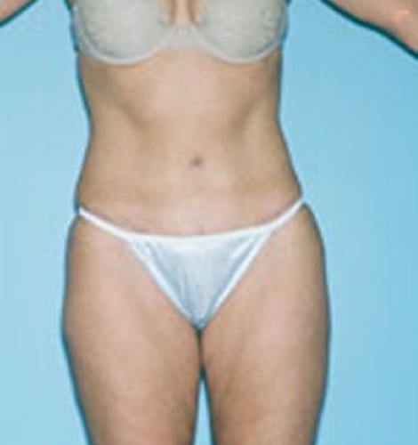 Tummy Tuck Before and After 25