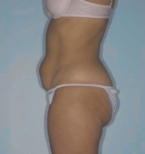 Tummy Tuck Before and After 44