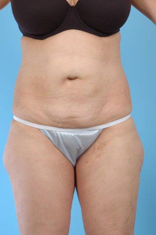 Tummy Tuck Before and After 46