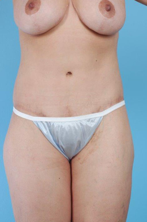 Tummy Tuck Before and After 47