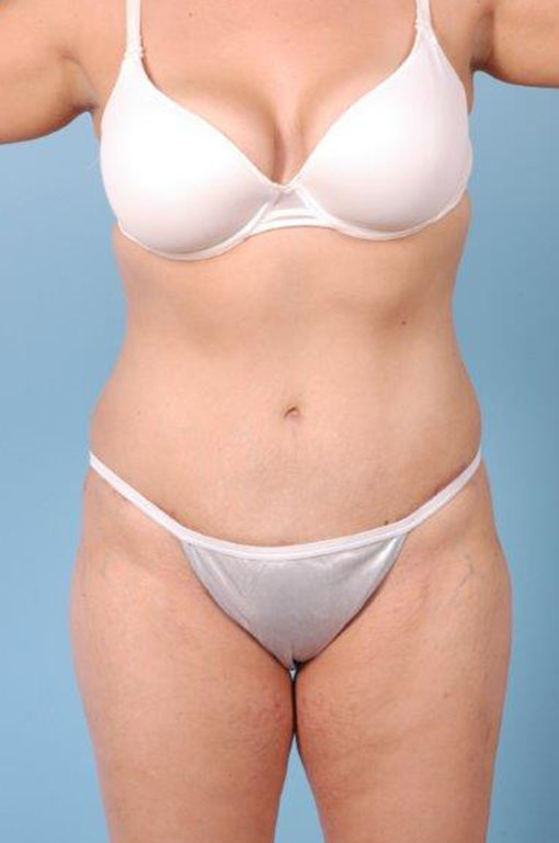 Tummy Tuck Before and After 11